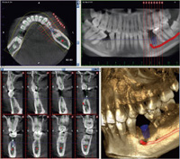 歯科用CTレントゲン画像